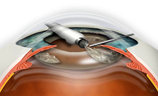 The refractive replacement of the lens is carried out through micronadle, which excludes blood loss