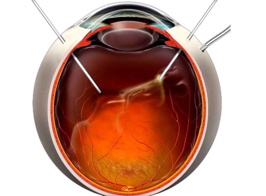 Vitrectomy - a procedure shown to people when retinal exfoliation